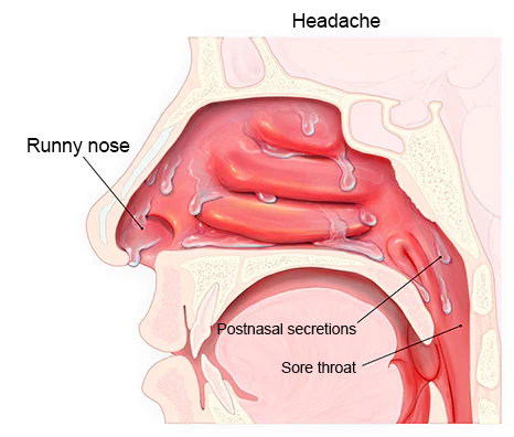 Nurbini™ RespiRelief red light nasal therapy device