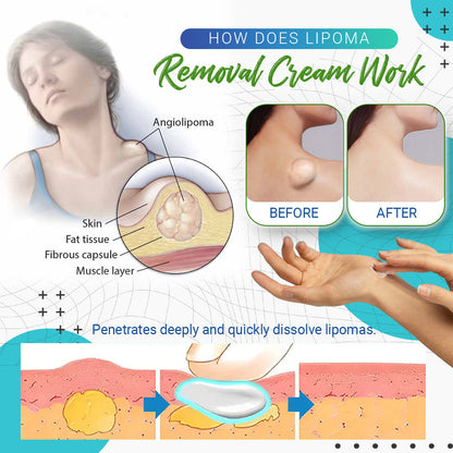 Dobshow™ Lipoma Removal Cream