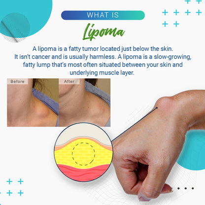 Dobshow™ Lipoma Removal Cream